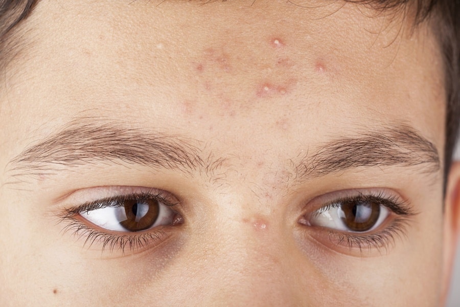 scannen Duwen Kritiek Hoe moet je scheren wanneer je acne hebt? - ScheerZone